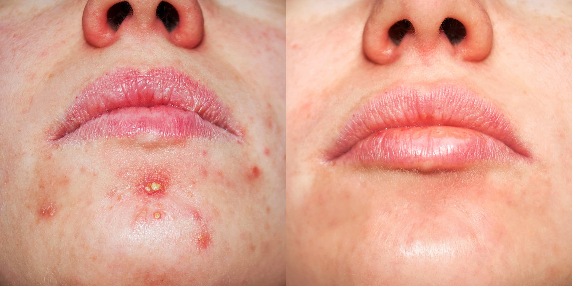 Dermatologia: acne cos’è e come si può curare