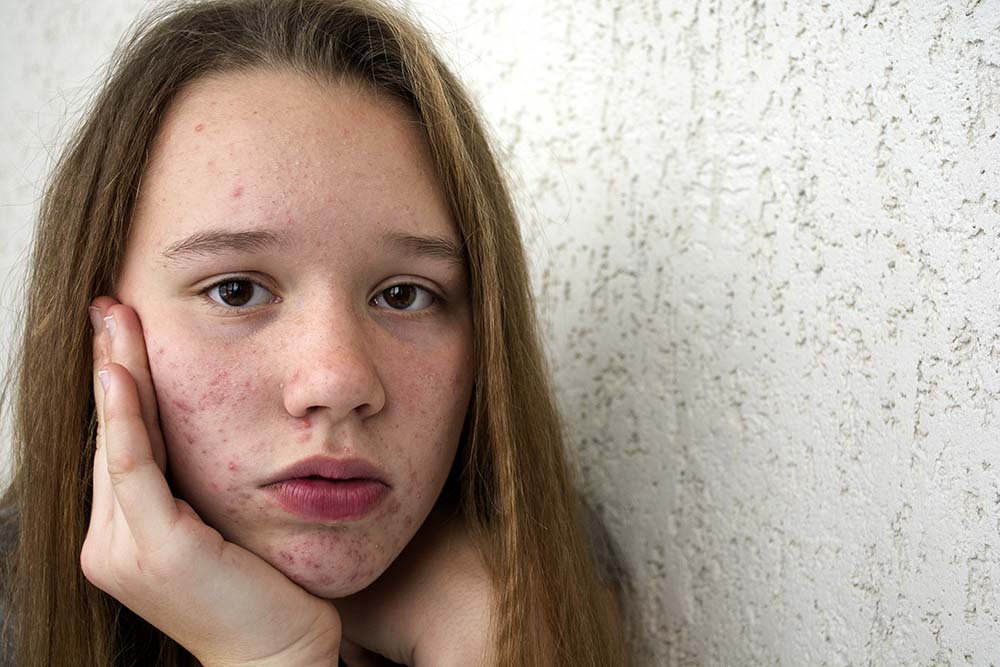 L'acne: una pataologia che si può sconfiggere