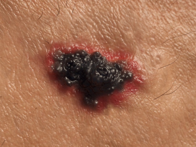 Dermatologia: il melanoma e i casi in crescita.