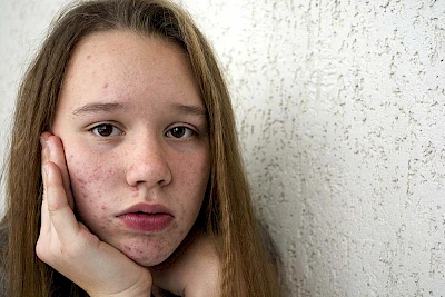 Acne? Meglio non affidarsi ai rimedi “fai da te”