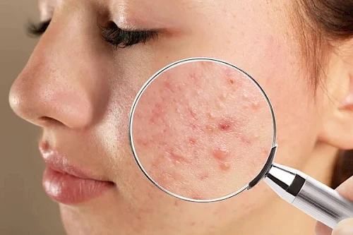Dermatologia: Fototerapia e acne, come funziona e perché è efficace.