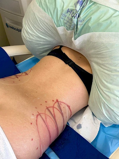 CoolSculpting Elite: la tecnologia non invasiva per la riduzione del grasso corporeo