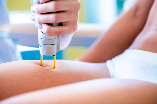 Dermatologia: epilazione laser