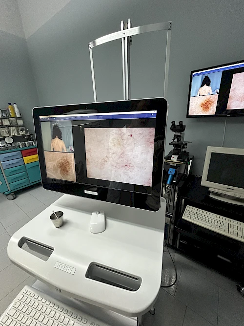 Dermatologia: Melanoma, nuove strategie terapeutiche e percorsi di cura