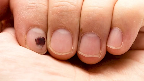 Dermatologia: Cos’è il melanoma acrale